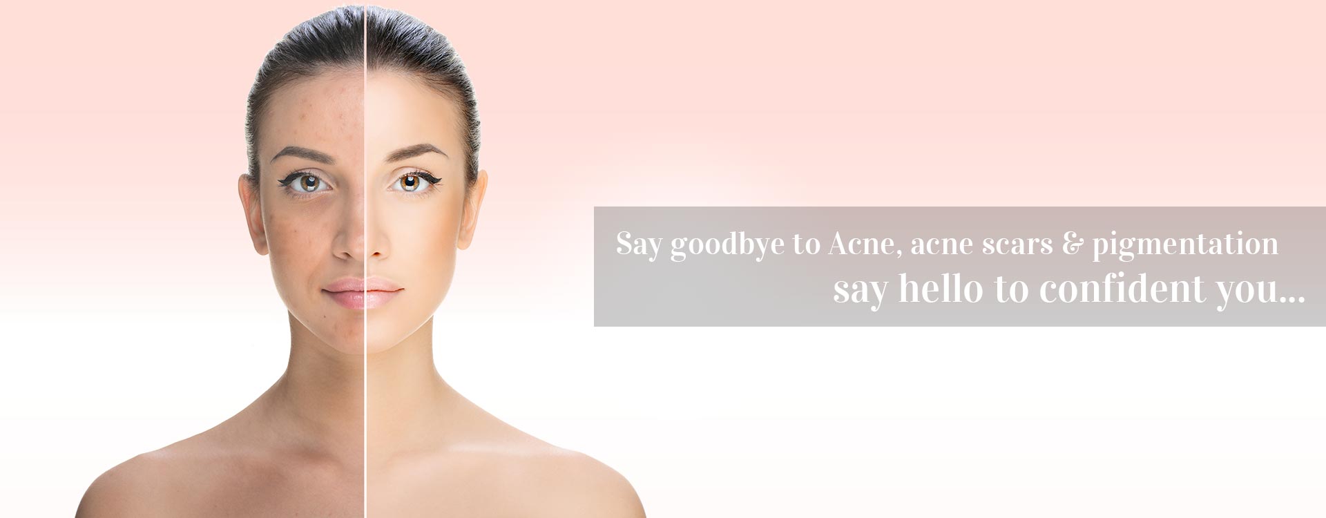 Acne Scar Removal Treatment in Noida